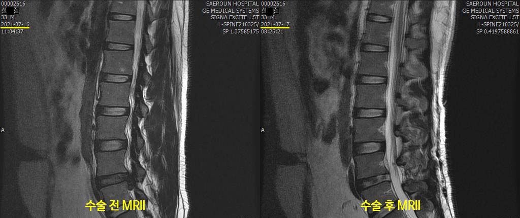 허리디스크 수술 전 후 MRI 사진